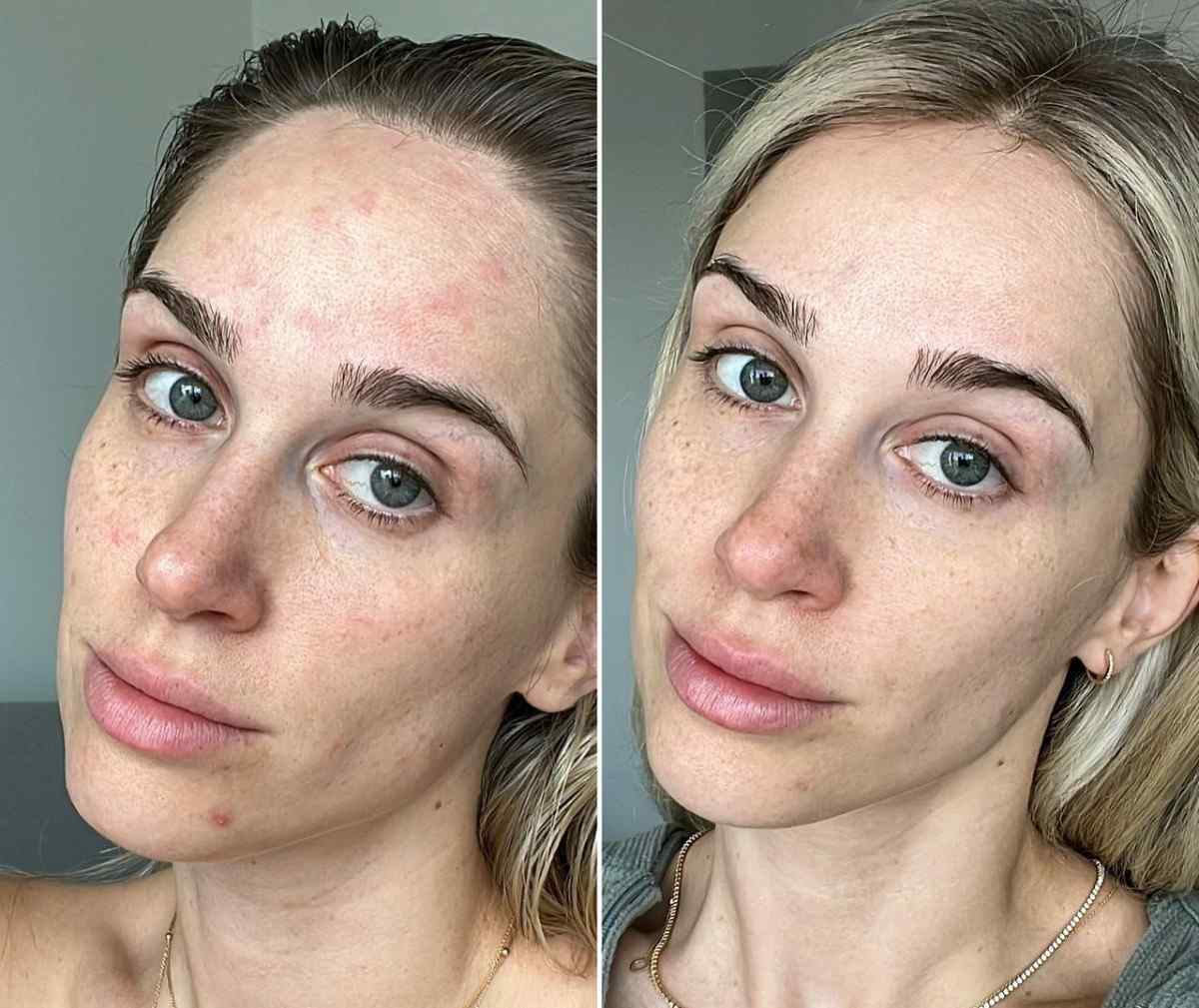 Anna risultati Eslow Skin pelle compatta